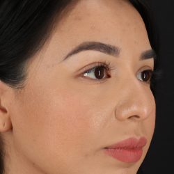 Chin Implant Before & After Patient #1626