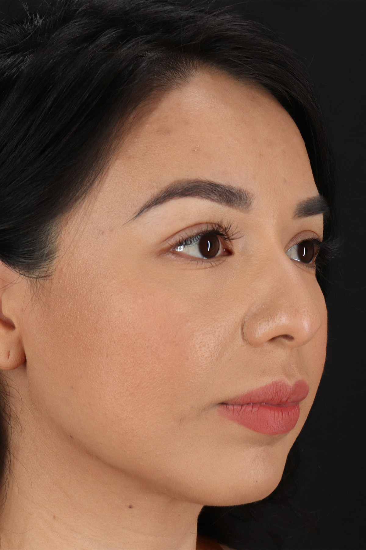 Chin Implant Before & After Patient #1626