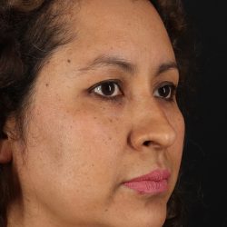 Rhinoplasty Before & After Patient #3225