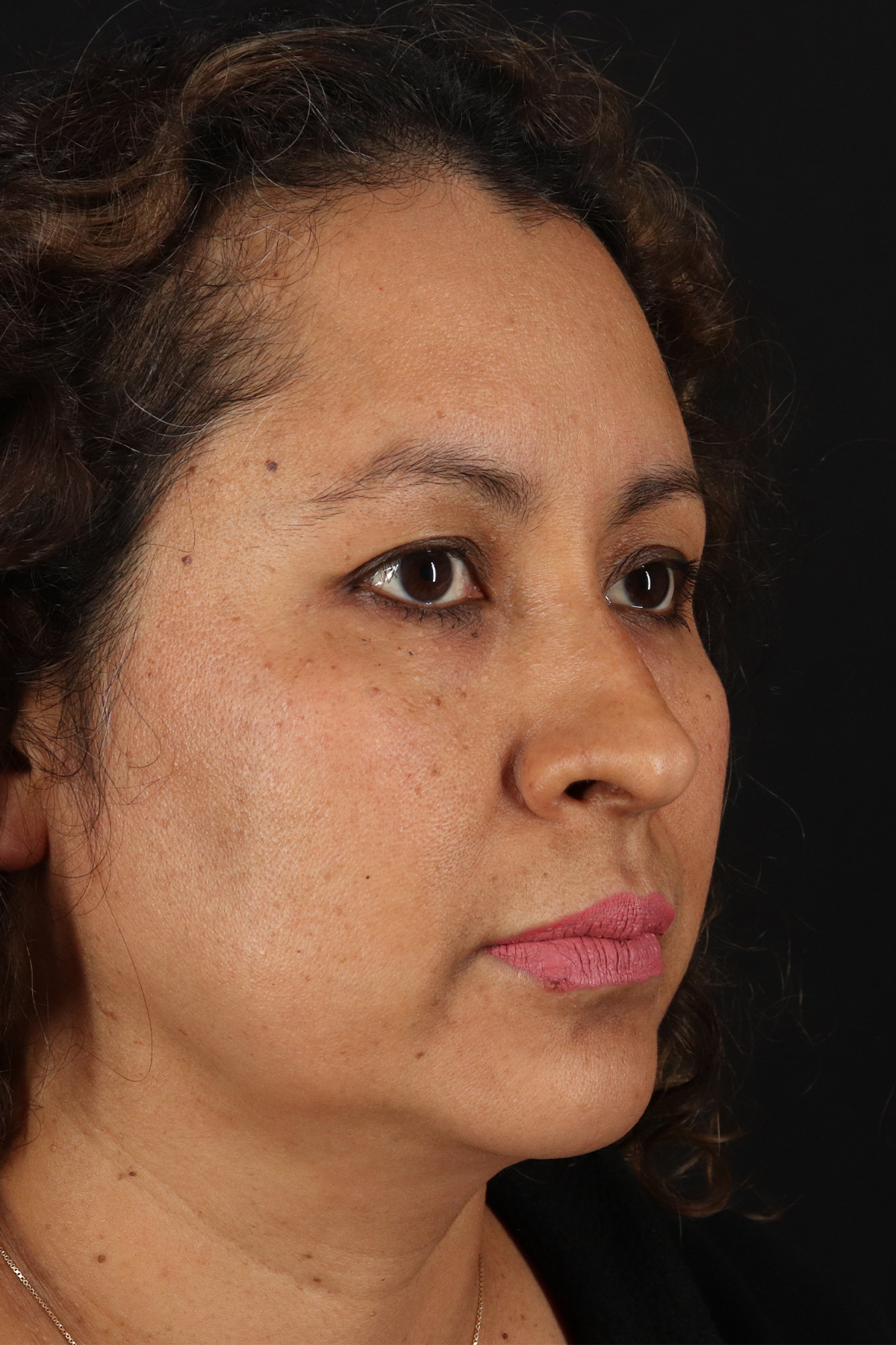 Rhinoplasty Before & After Patient #3225