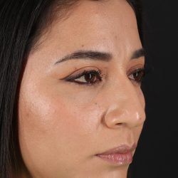 Rhinoplasty Before & After Patient #3082