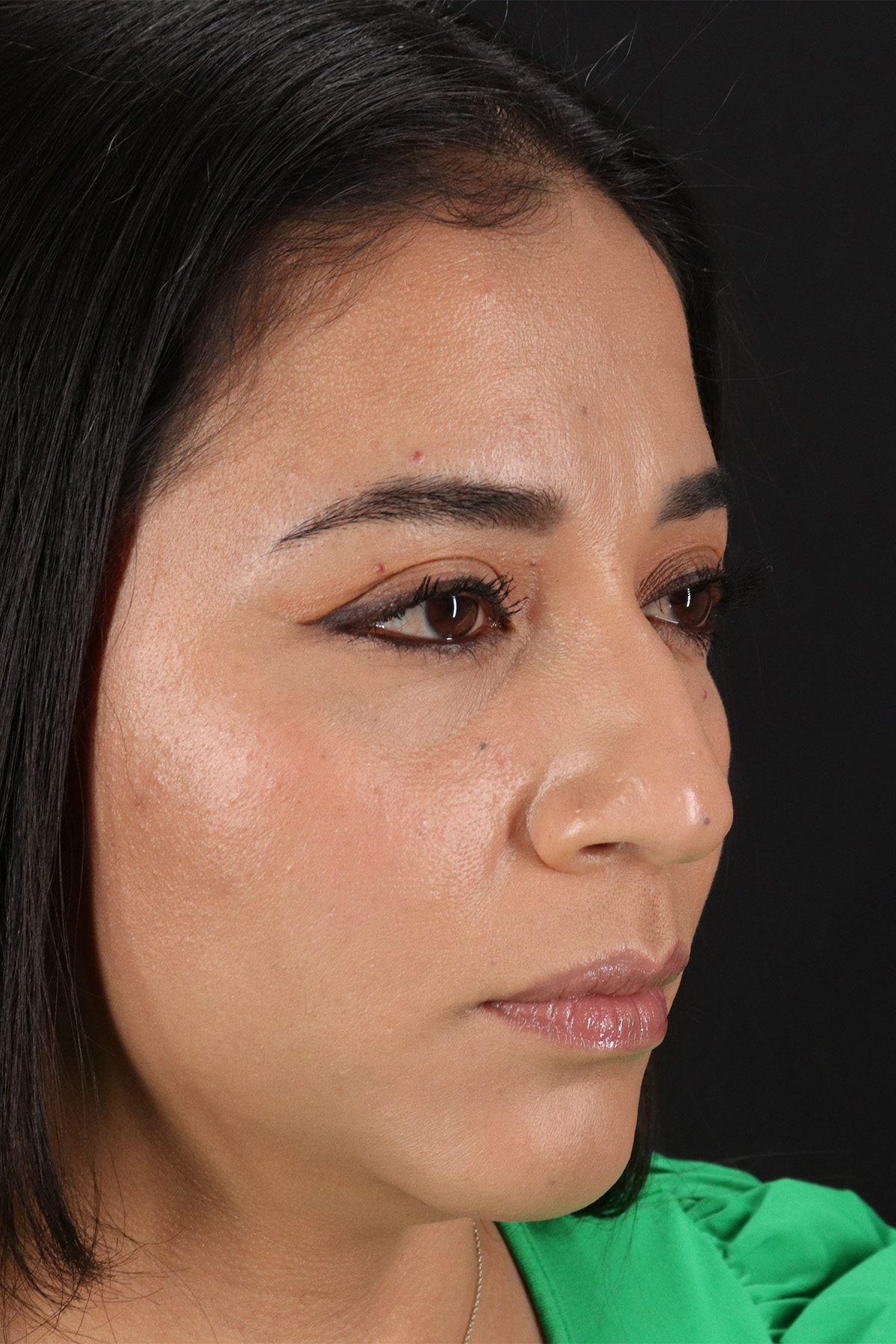 Rhinoplasty Before & After Patient #3082