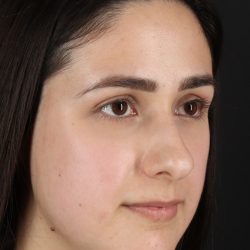 Liquid Rhinoplasty Before & After Patient #2188