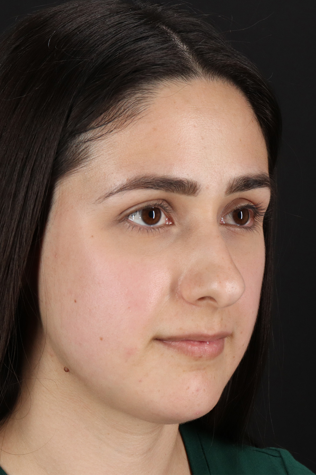 Liquid Rhinoplasty Before & After Patient #2188