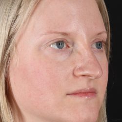 Rhinoplasty Before & After Patient #3126