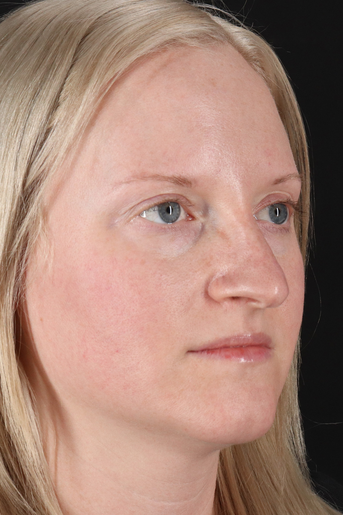 Rhinoplasty Before & After Patient #3126