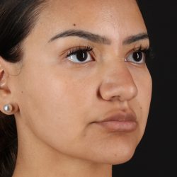 Rhinoplasty Before & After Patient #3192