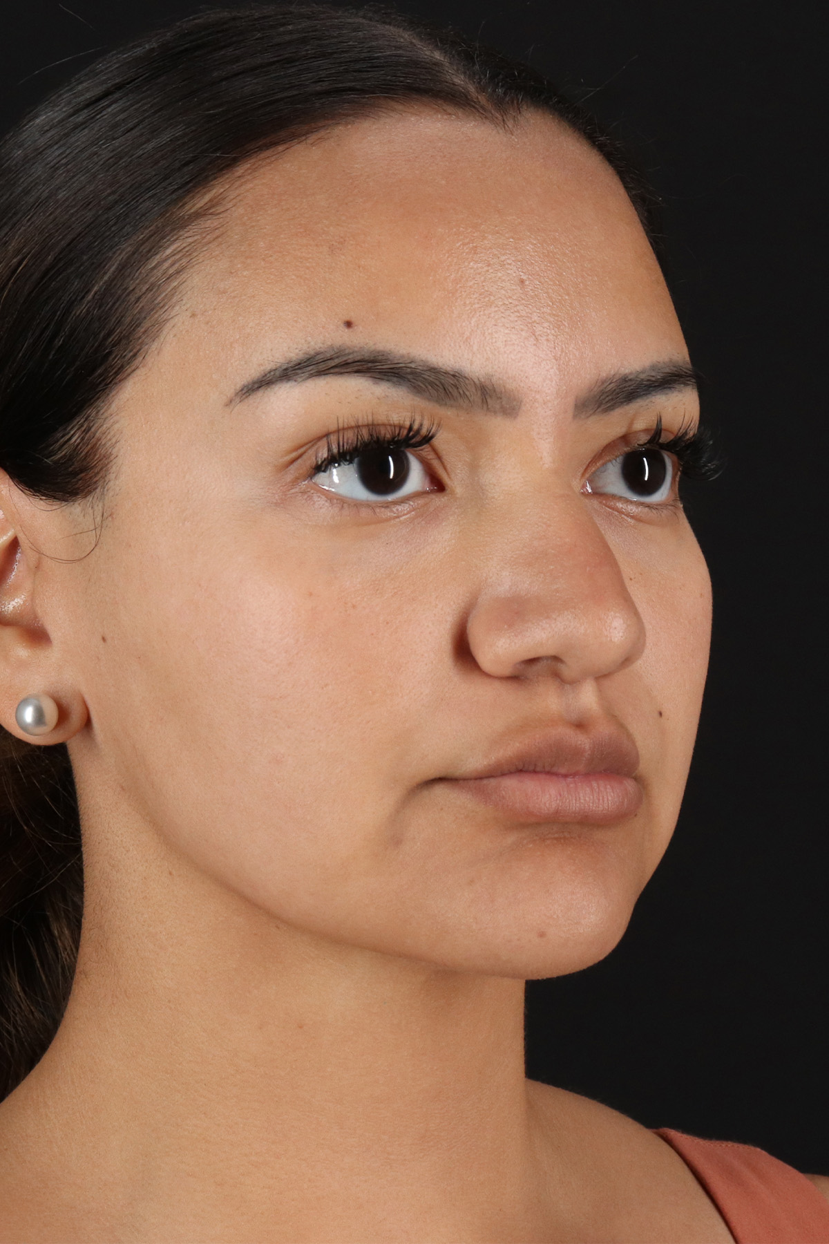 Rhinoplasty Before & After Patient #3192