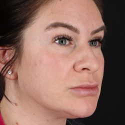 Rhinoplasty Before & After Patient #3093