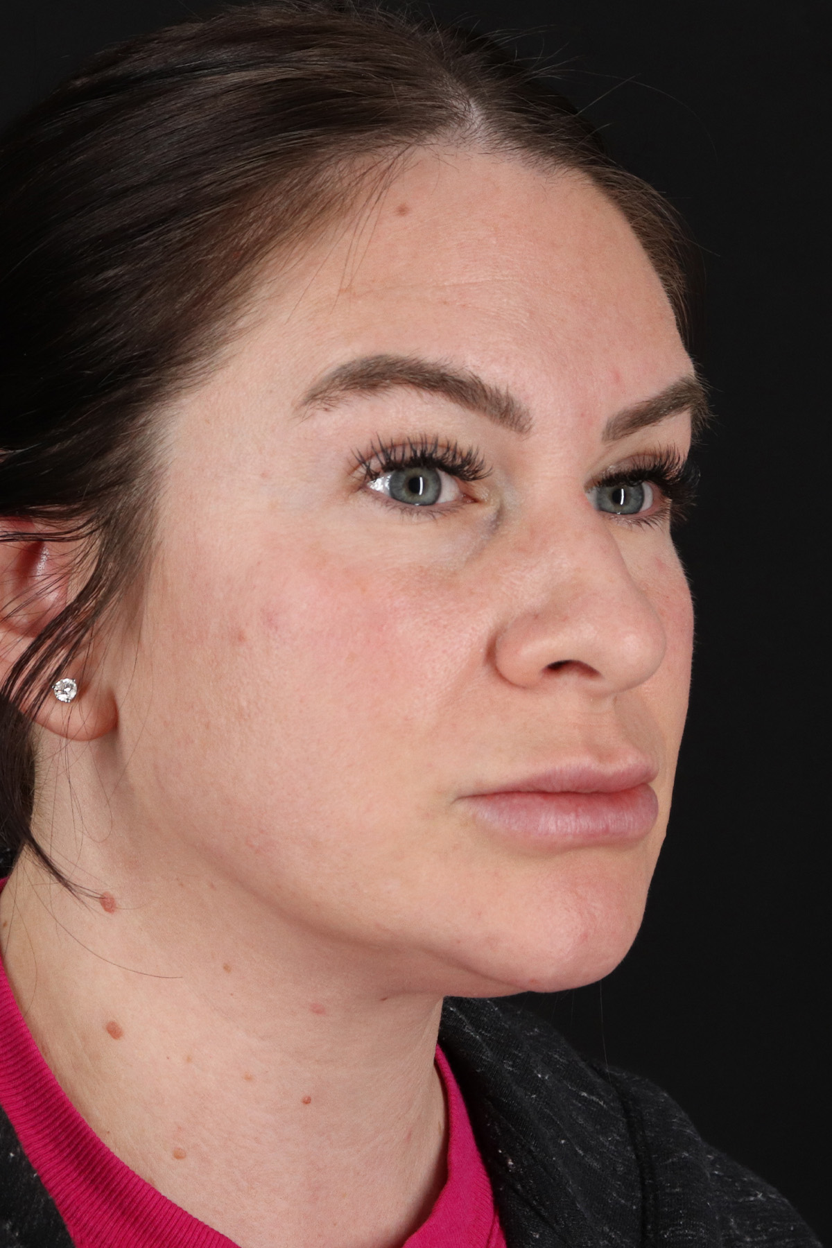 Rhinoplasty Before & After Patient #3093