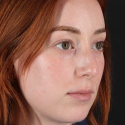 Rhinoplasty Before & After Patient #3170