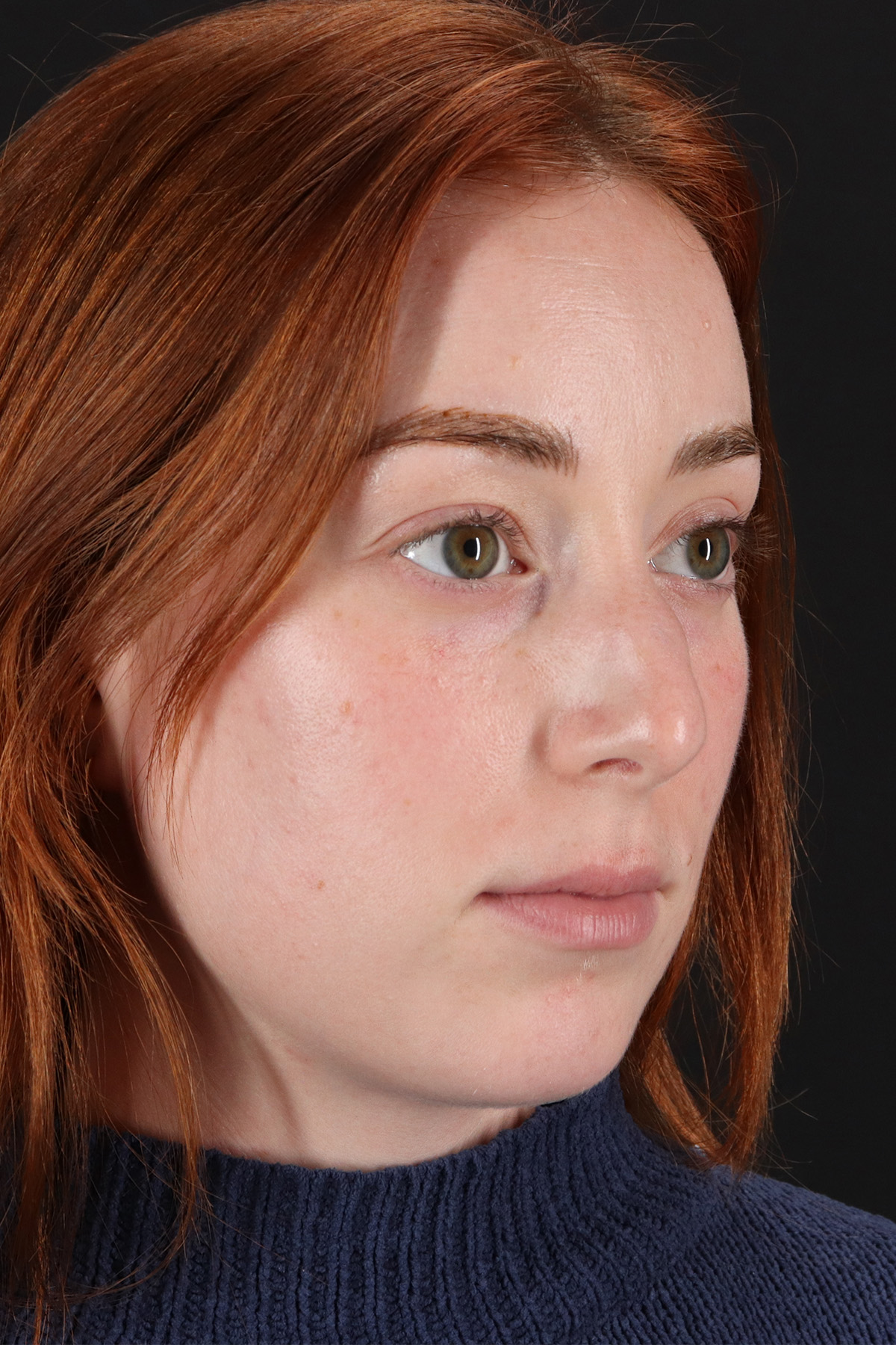 Rhinoplasty Before & After Patient #3170