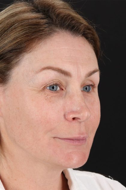 Lip Lift Before & After Patient #2144