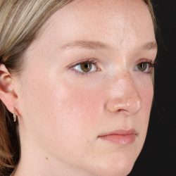 Liquid Rhinoplasty Before & After Patient #2177