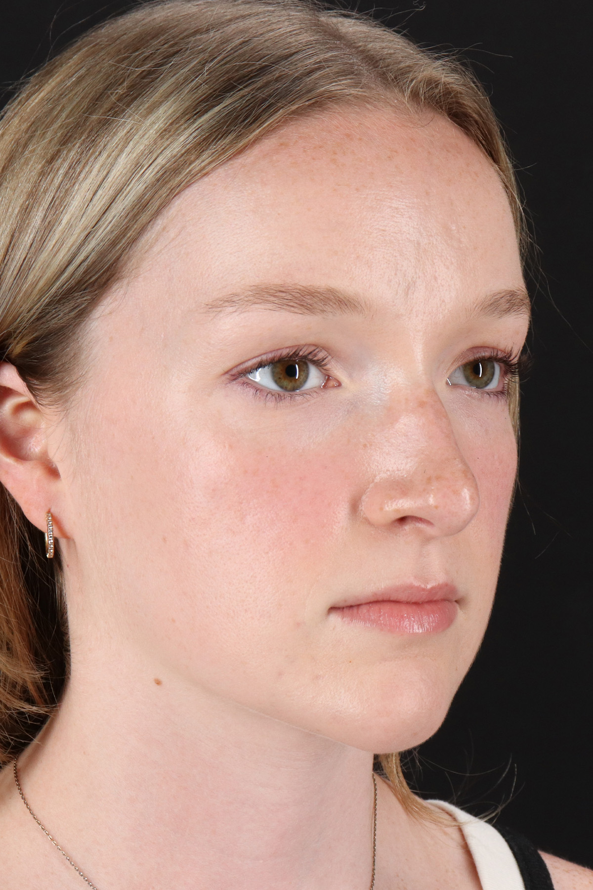 Liquid Rhinoplasty Before & After Patient #2177