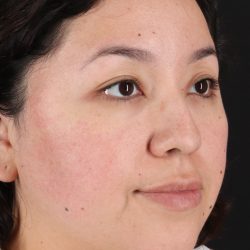 Rhinoplasty Before & After Patient #3060