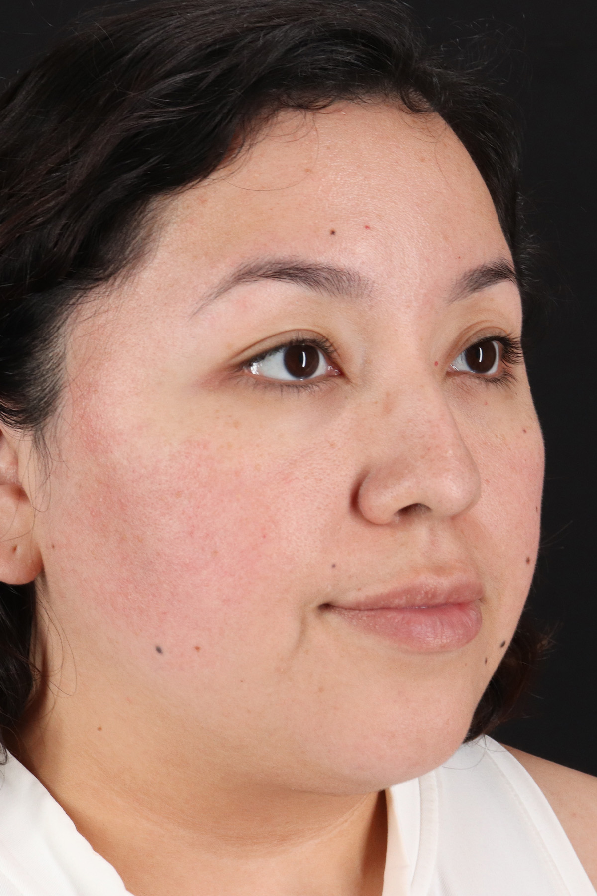 Rhinoplasty Before & After Patient #3060