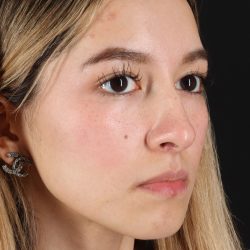 Rhinoplasty Before & After Patient #3302