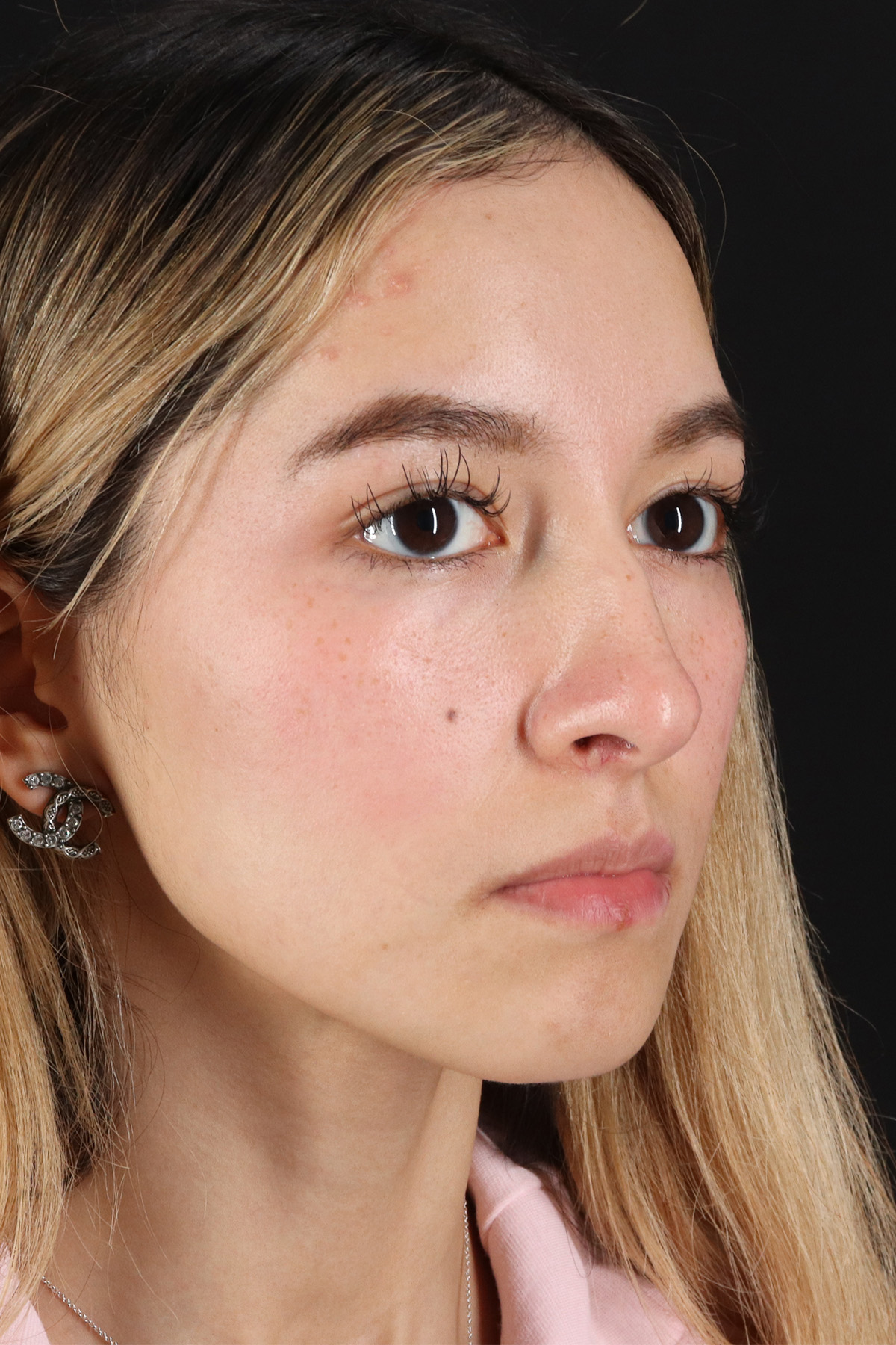 Rhinoplasty Before & After Patient #3302