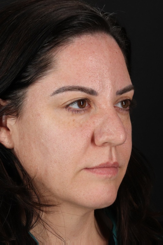 Browlift Before & After Patient #1363