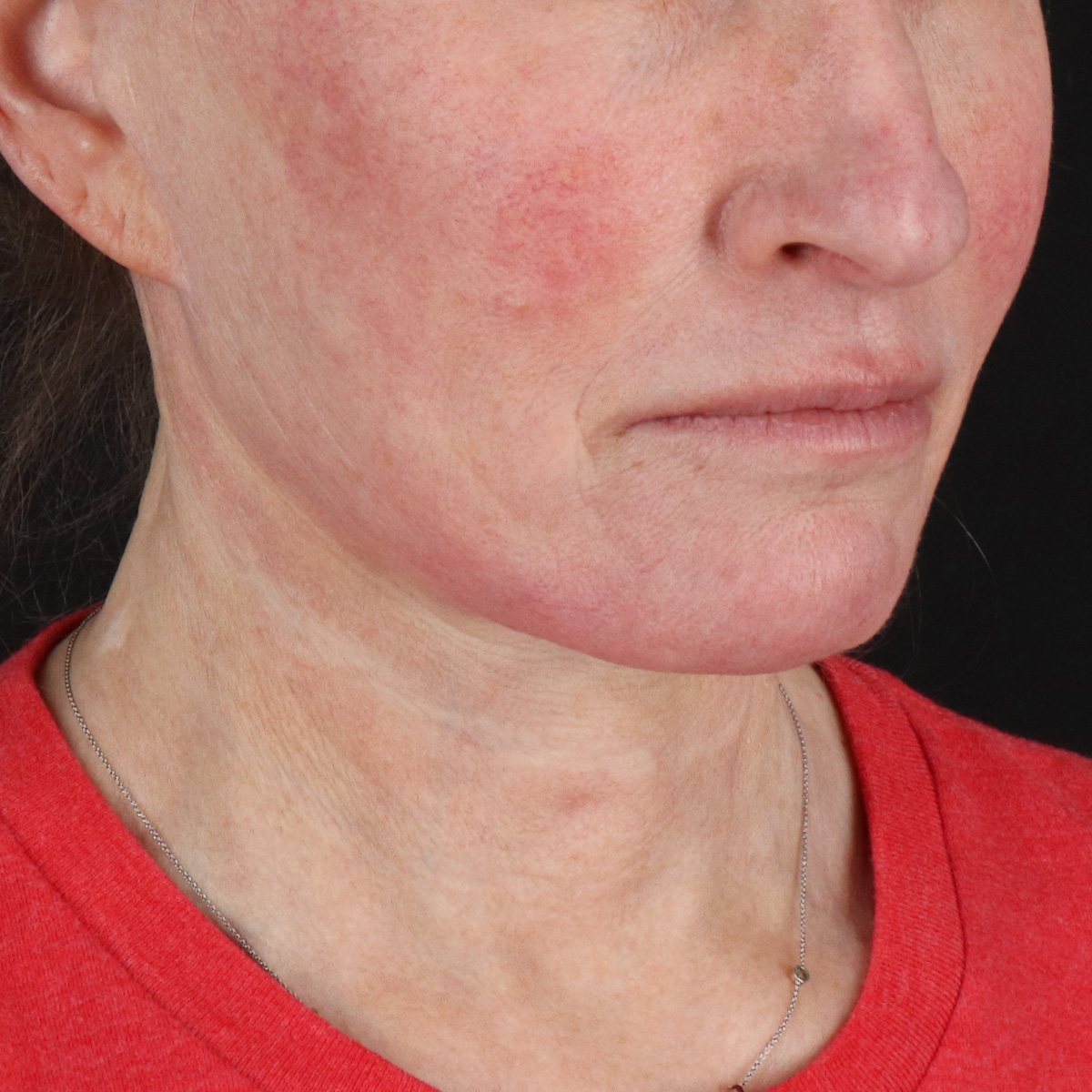 Facelift Before & After Patient #1866