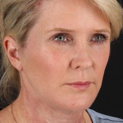 Facelift Before & After Patient #1877