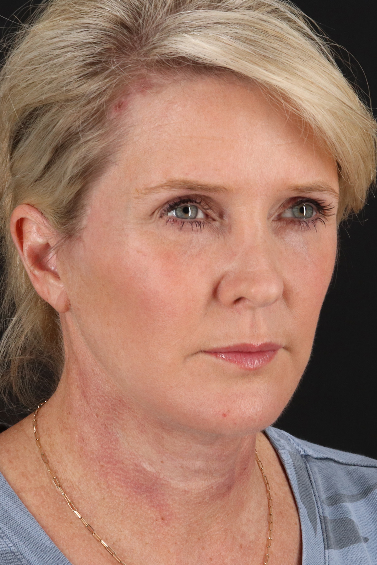 Facelift Before & After Patient #1877