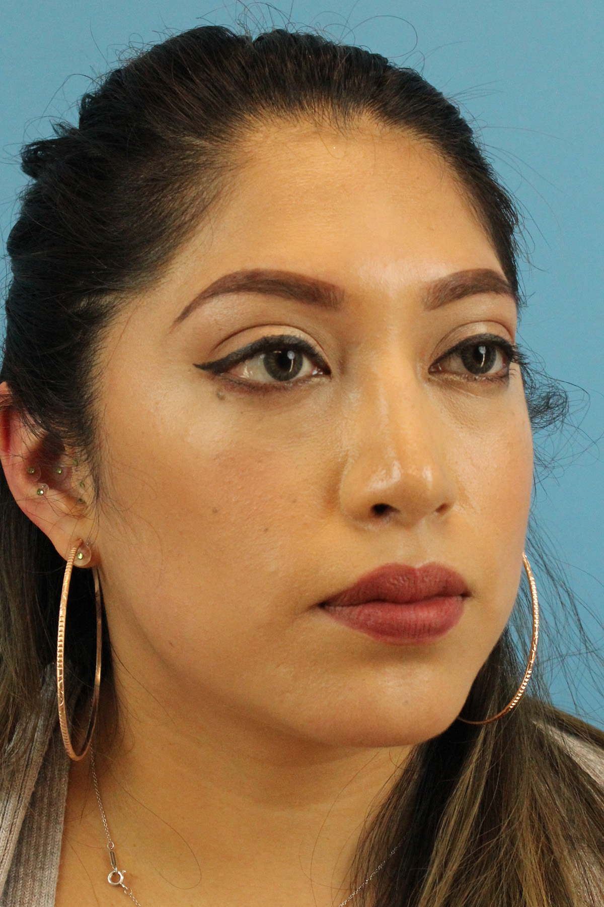 Chin Implant Before & After Patient #1670