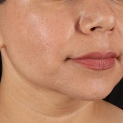 Facelift Before & After Patient #3555