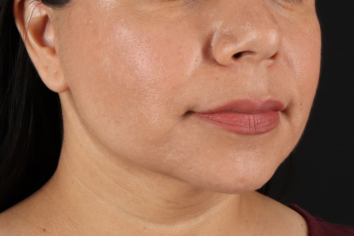 Facelift Before & After Patient #3555