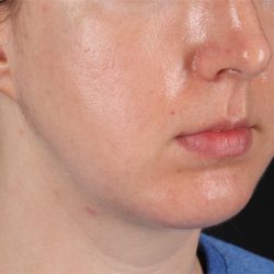 Chin Implant Before & After Patient #1562