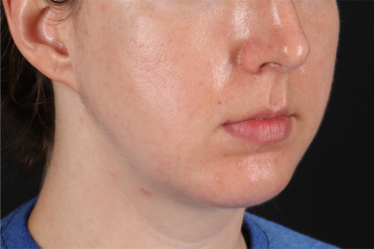Chin Implant Before & After Patient #1562