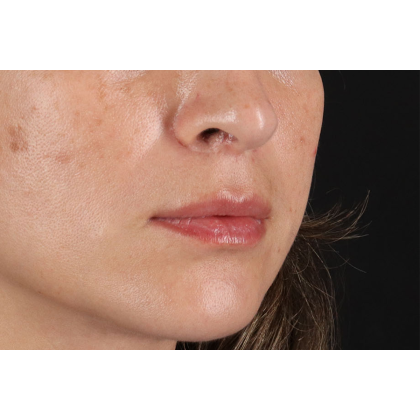 Lip Lift Before & After Patient #2166