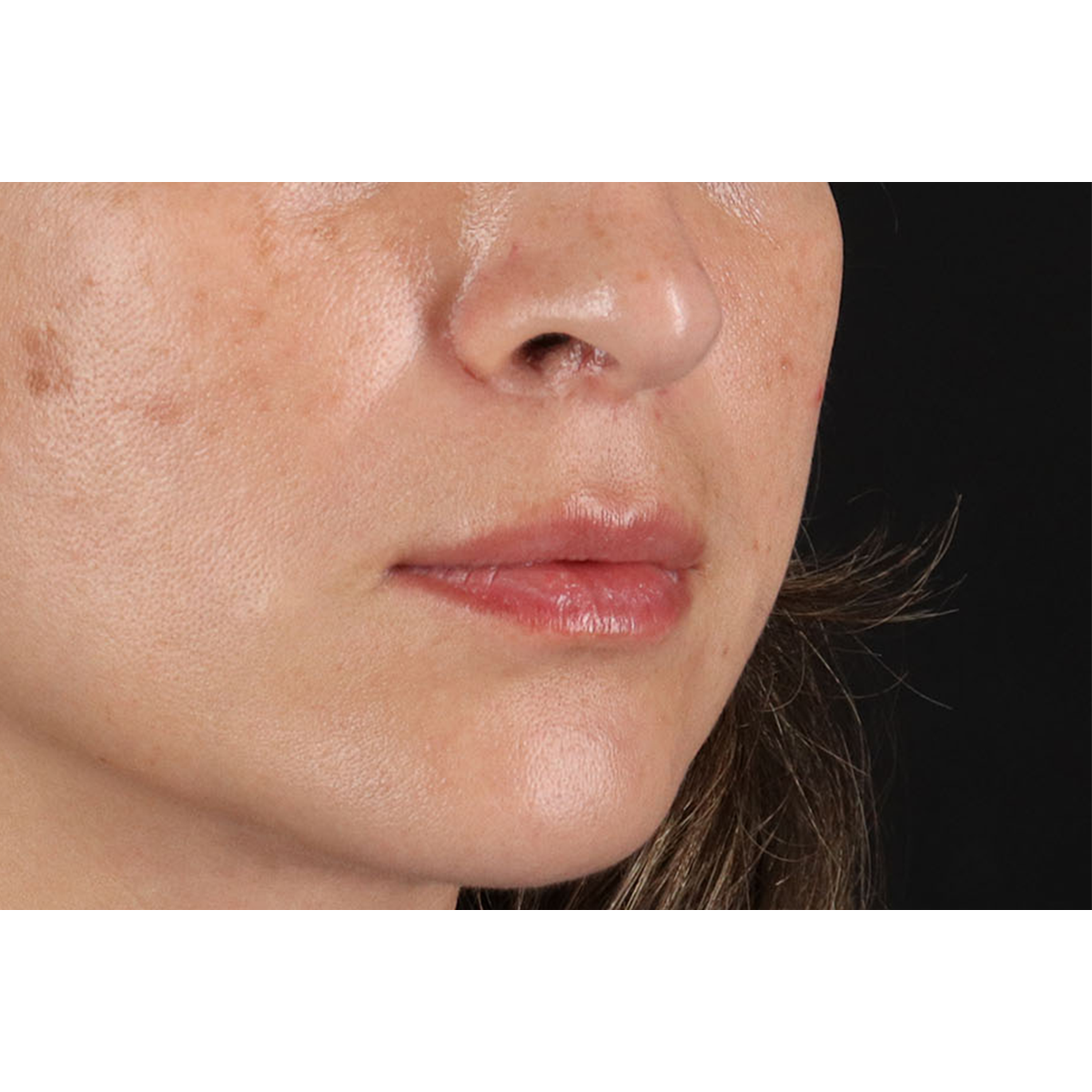 Lip Lift Before & After Patient #2166