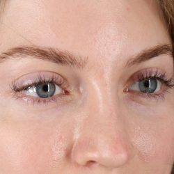 Browlift Before & After Patient #1319