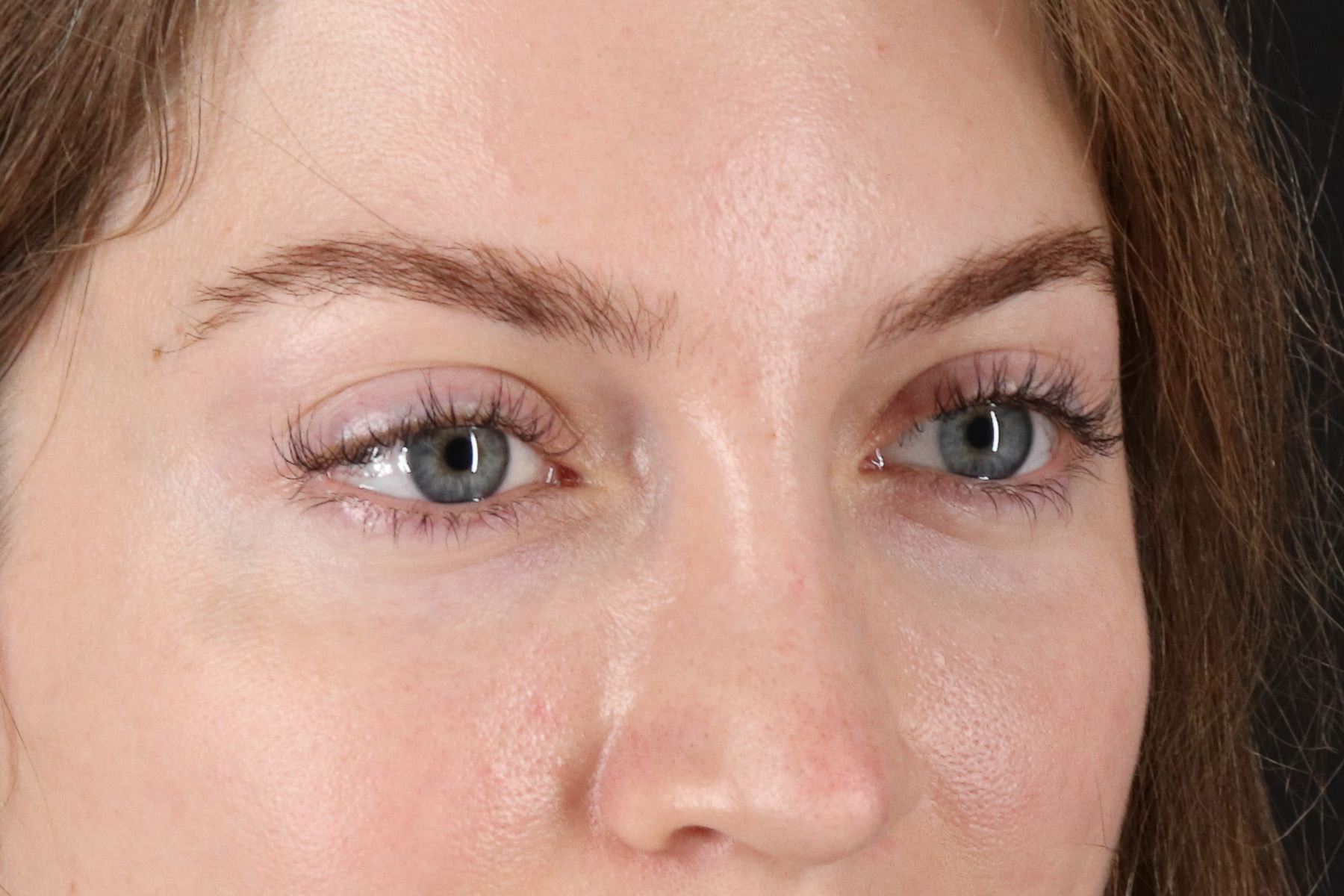 Browlift Before & After Patient #1319