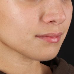 Chin Implant Before & After Patient #1573