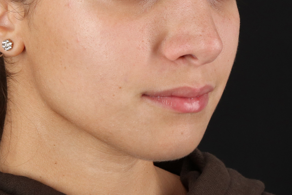 Chin Implant Before & After Patient #1573