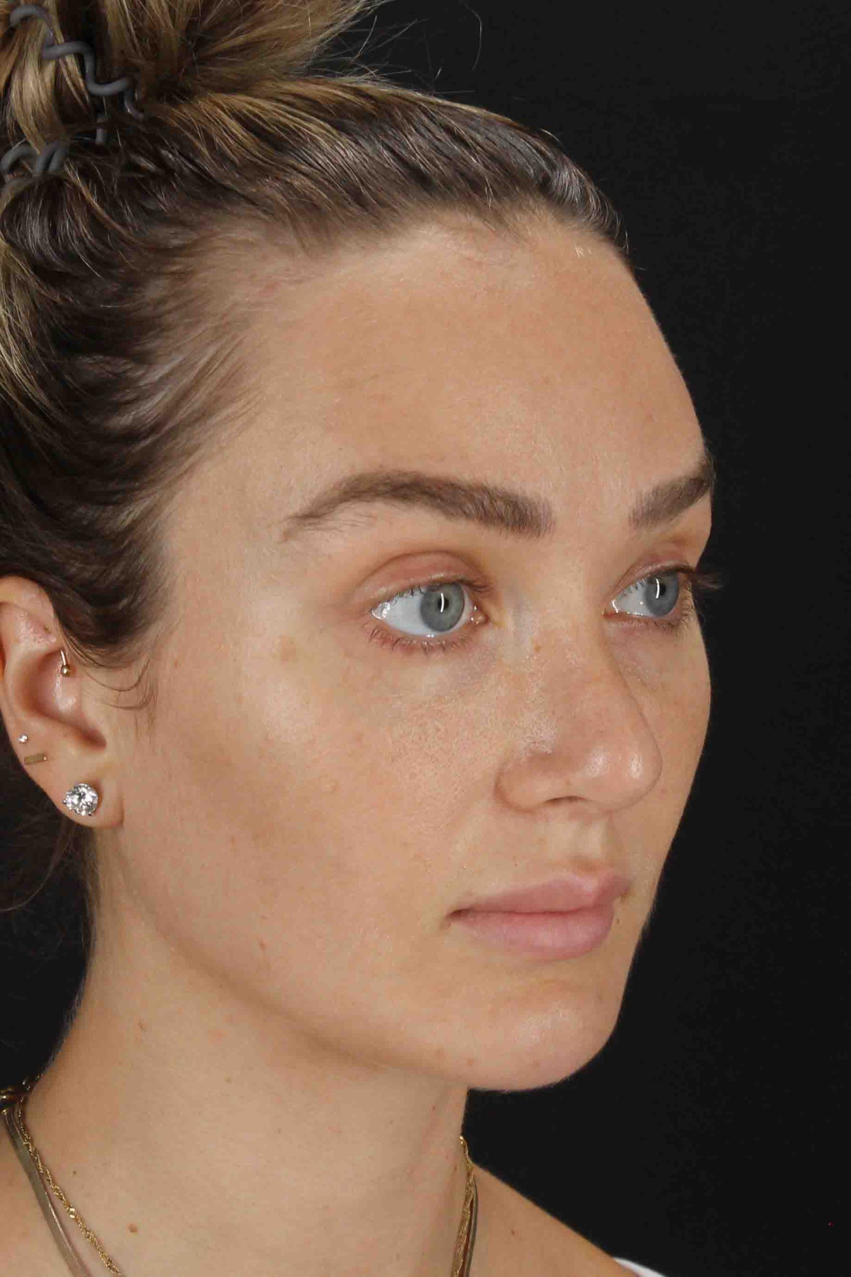 Browlift Before & After Patient #1297