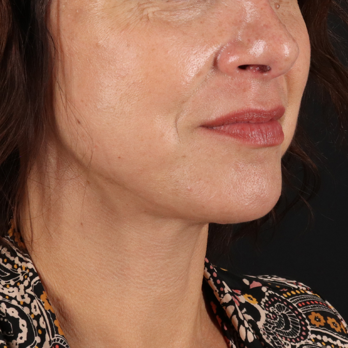 Facelift Before & After Patient #1809