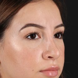 Rhinoplasty Before & After Patient #3247