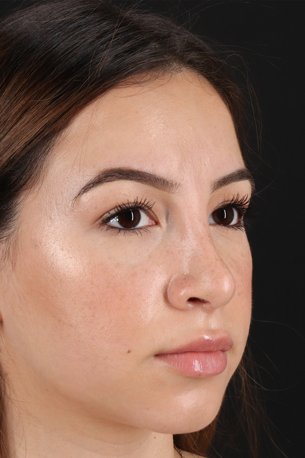 Rhinoplasty Before & After Patient #3247