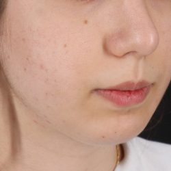 Chin Implant Before & After Patient #1551