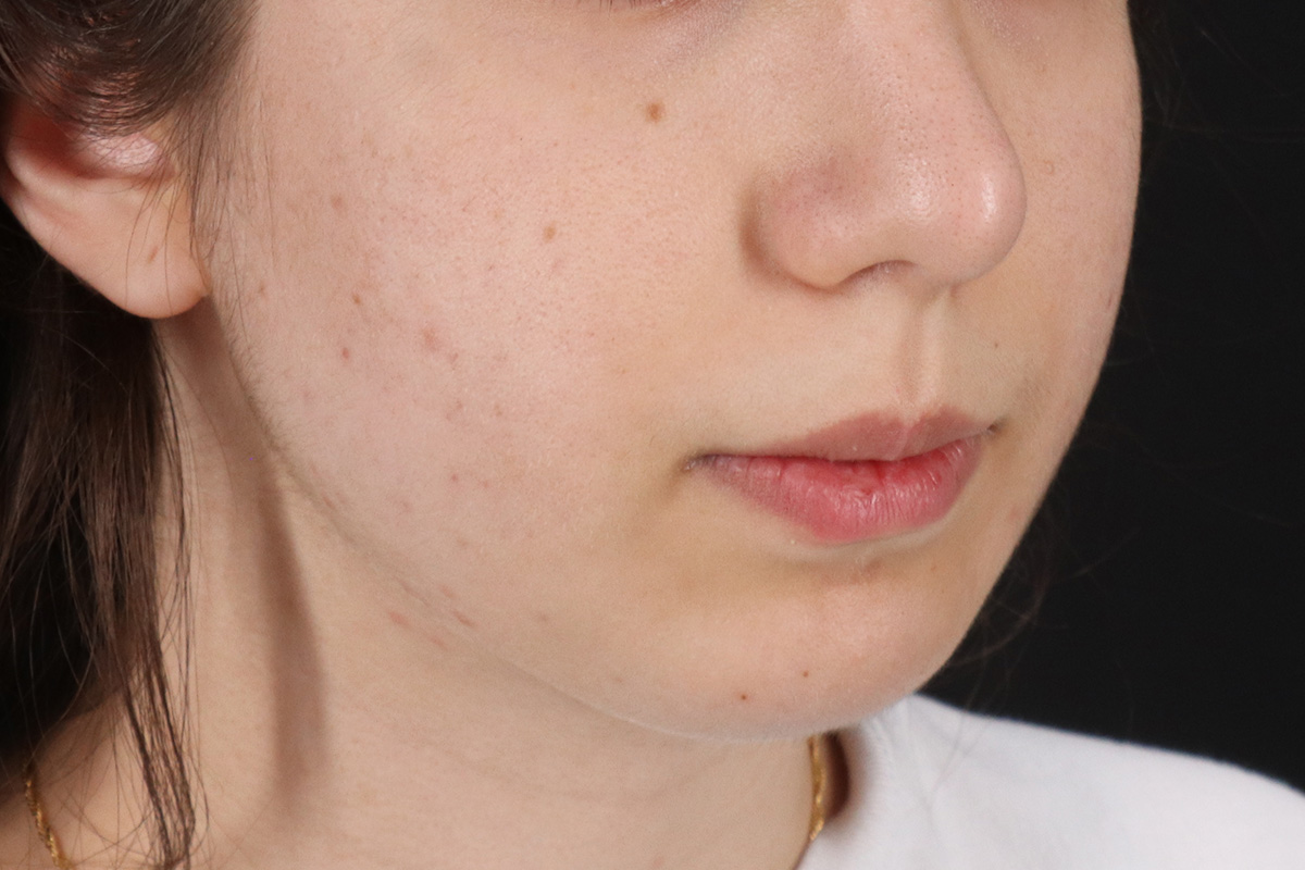 Chin Implant Before & After Patient #1551