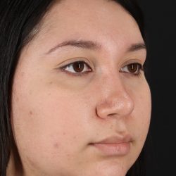 Chin Implant Before & After Patient #1604