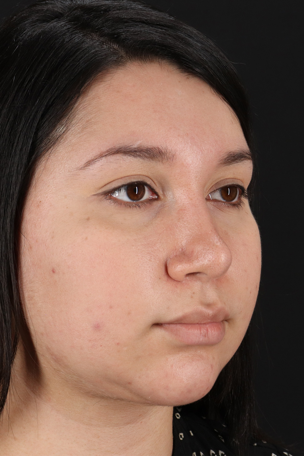 Chin Implant Before & After Patient #1604