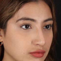 Liquid Rhinoplasty Before & After Patient #2254