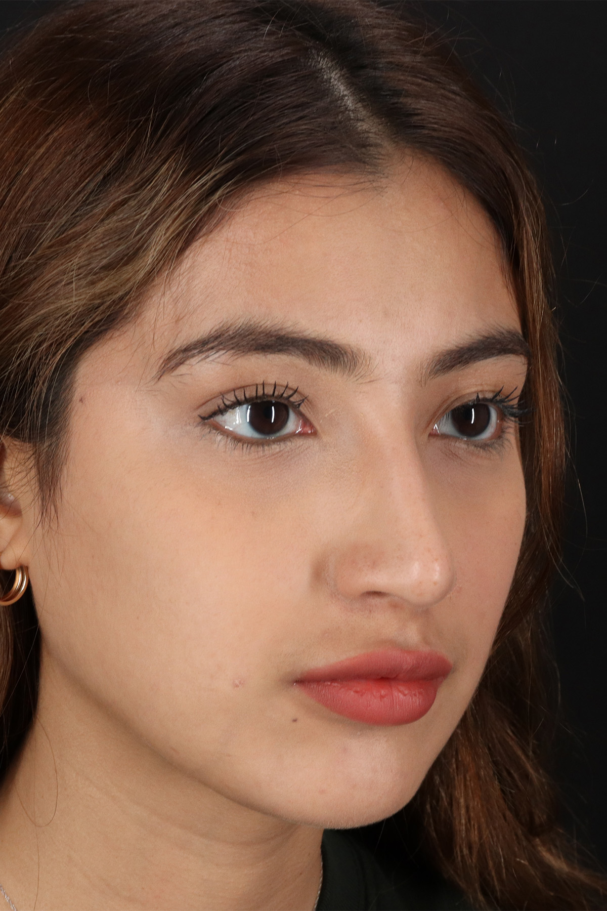 Liquid Rhinoplasty Before & After Patient #2254