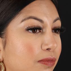 Rhinoplasty Before & After Patient #3049
