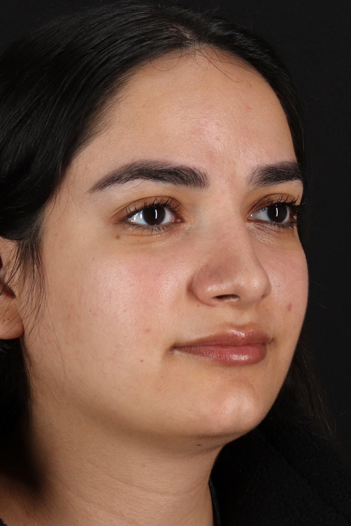 Rhinoplasty Before & After Patient #3071